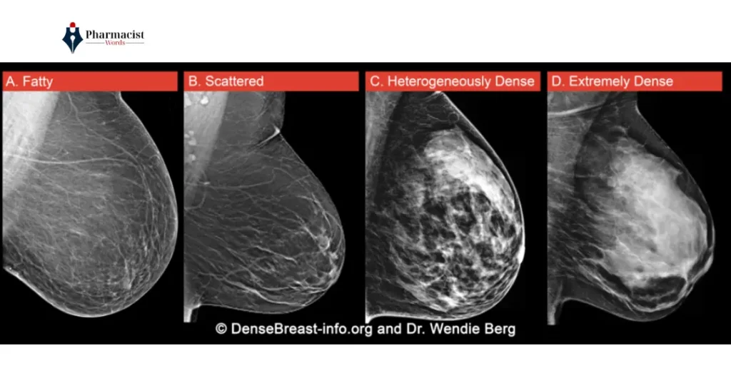 BI-RADS Category 4 Explained: Risk, Biopsy & Meaning